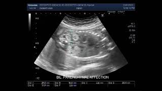 Fetal echogenic Kidneys with a distended urinary bladder [upl. by Lled]