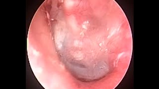 Suction Clearance 6 weeks after Tympanoplasty amp Mastoidectomy to see newly formed eardrum [upl. by Eelrahs]