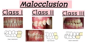 malocclusionsClass IClass IIClass IIIClinical featuresQuick Revision [upl. by Hillyer]