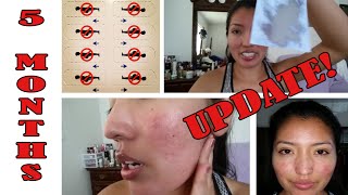 5 Months on Isotretinoin Accutane  Update amp Blood Tests [upl. by Pearce]