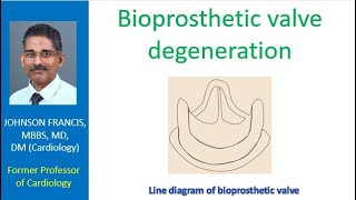 Bioprosthetic valve degeneration [upl. by Homovec]