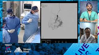 Embolization of a Recurrent Hand Arteriovenous Malformation AVM using NBCA Liquid Embolic [upl. by Malvia209]