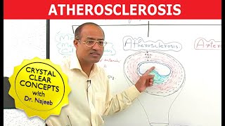 Atherosclerosis  Pathophysiology [upl. by Easton]