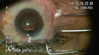 phacoemulsification in Small pupil USING MYDRANE from thea in the start [upl. by Suirtemid]