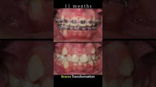 Braces crooked teeth braces orthodontist beforeandafter dentist orthodontictreatment [upl. by Areema]