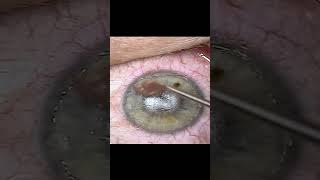 Manual Epithelial Removal Epicell [upl. by Lledo532]