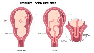 Surviving Umbilical Cord Prolapse And HIE [upl. by Natsyrk]