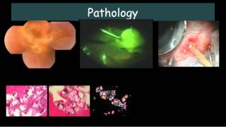 Bilateral Exudative retinal detachment with subretinal exudates Dr E M Dodds [upl. by Ahseikram771]