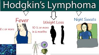 Hodgkins lymphoma Hodgkins disease  Symptoms and treatment How to detect lymphoma [upl. by Race]