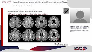 ESOC 2024 on demand session quotHow to Diagnose and Approach Incidental amp Covert Small Vessel Diseasequot [upl. by Timms]