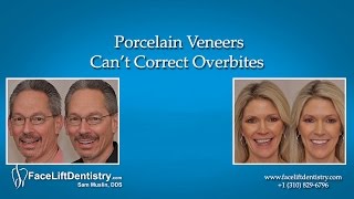 Porcelain Veneers Can’t Correct Overbites [upl. by Lleira699]