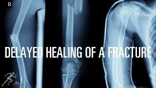 What can cause a fracture to have delayed healing [upl. by Ainna]