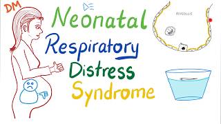 Neonatal Respiratory Distress Syndrome NRDS  Pediatrics  Pulmonology [upl. by Slotnick142]