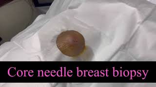 Core needle breast biopsy [upl. by Htebasile]