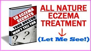 Eczema Treatment  How To Get Rid Of Eczema Naturally [upl. by Claiborn]