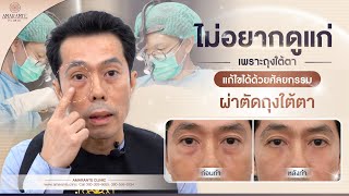 🚩 รีวิวผ่าตัดถุงใต้ตา แก้ไขปัญหาถุงใต้ตาหย่อนคล้อย ที่ Amarante Clinic [upl. by Euqnom]