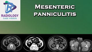 Mesenteric panniculitis [upl. by Ardnua782]