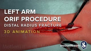 Left Arm ORIF Procedure of Distal Radius Fracture  3D Medical Animation [upl. by Okimat]