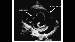 Hypokinesia Dyskinesia and Akinesia in a Single Echocardiography Frame [upl. by Dickinson]