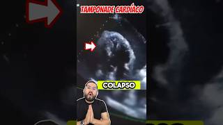 Derrame pericárdico que condiciona TAMPONADE 🫀 emergency [upl. by Beau]