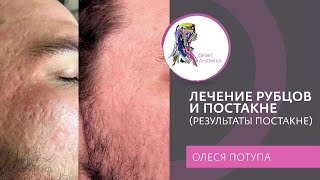 Лечение рубцов постакне 3 клинических кейса 💉💉💉 [upl. by Armmat242]