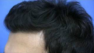 Dr Hasson  Repair to FUE and Hair Transplant [upl. by Ecirtap]