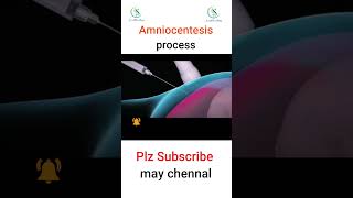 Amniocentesis process Do you know why amniocentesis is needed pregnant foryou amniocentesis [upl. by Seraphim]