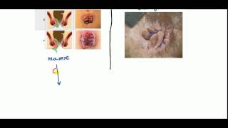 Hemorrhoids Lecture for USMLE [upl. by Killie203]