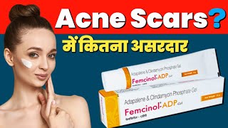 Adapalene Gel On Face  Femcinol ADP  Clindamycin Phosphate Gel  Acne Scars Treatment [upl. by Micky]