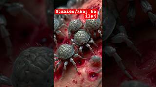 Scabies treatment scabies shortsdiljitdosanjh ytshortsindia [upl. by Anelrad]