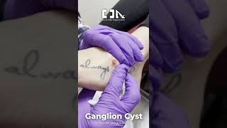 Ganglion Cyst Quiste ganglionar  DrOrlando Nuñez 👨‍⚕️  Minimally Invasive Foot Surgery [upl. by Anyal826]