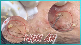 Big Cystic Acne Blackheads Extraction Blackheads amp Milia Whiteheads Removal Pimple Popping [upl. by Acirret]