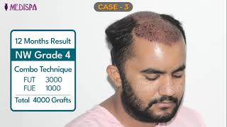 Best Hair Transplant Results compilation lower and higher grade by Dr Suneet at Medispa India [upl. by Lotson]