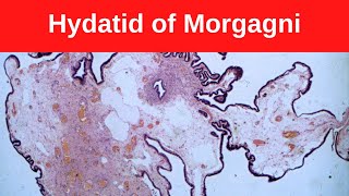 Hydatid of Morgagni  Pathology mini tutorial [upl. by Gaidano]