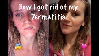 How I Cured My Perioral Dermatitis [upl. by Anikas373]