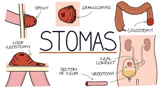 Understanding Stomas Colostomy Ileostomy Urostomy and Gastrostomy [upl. by Dlorag]