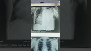 Normal VS massive pleural effusion x ray doctors viralvideo viralreels viralshort viralsong [upl. by Leakim]