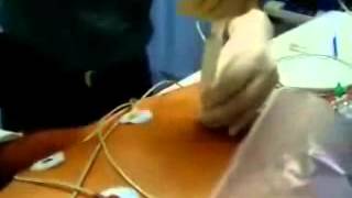 Toracocentesis con aguja en Neumotorax a tensionwmv [upl. by Ecertal]