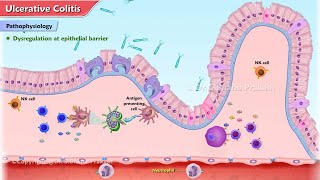 Ulcerative Colitis Animation  Etiology Clinical features Pathophysiology Diagnosis Treatment [upl. by Wahlstrom]