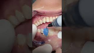 Deep caries with Composite veneer dentist [upl. by Reinwald]