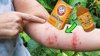 Escape the POISON IVY ITCH Natural Home Remedies for Poison Ivy Rash [upl. by Branen434]