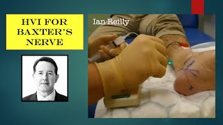 Video  Baxters nerve entrapment high volume injection hydrodissection using nerve stimulator [upl. by Bennion703]