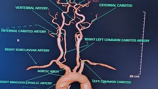 BRAIN AND NECK ANGIOGRAPHY On ct scanALL ABOUT ANGIOGRAPHYPART2CONCEPT ON ANGIOGRAPHY [upl. by Ott]