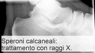 Radioterapia per sperone calcaneare caratteristiche e principi di trattamento [upl. by Enamart190]