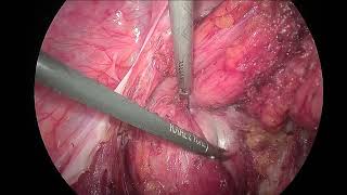 Laparoscopic Excision of a sacrococcygeal teratoma [upl. by Anitroc]