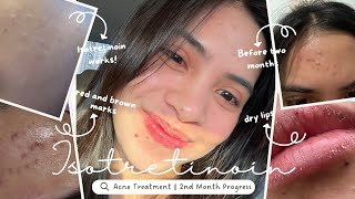 Accutane Journey  Two Months Progress Road to Clear Skin [upl. by Arbrab278]