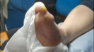 Pedicure Tutorial  Dead skin removal and Cracked heels treatment Callus removal from feet [upl. by Lednek]