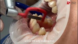 DentaSonic IPR Sequence Steps  Interproximal Reduction Strips [upl. by Anisah]