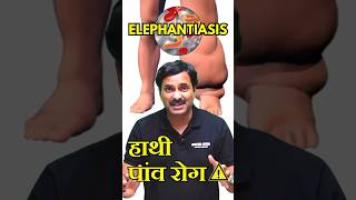 Elephantiasis Filariasis  हाथी पांव रोग 😰 disease neetpreparation neetexam [upl. by Agnot]