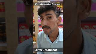 Hyperpigmentation Treatment skincare Hyperpigmentation pigmentation skinwhitening [upl. by Assyn]